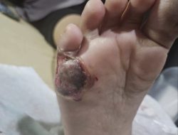 Kaki Melepuh Usai Melahirkan, RSU Sarah Medan Digugat Pasien